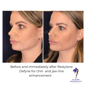 before-and-immediately-after-restylane-defyne-for-chin-enhancement-4