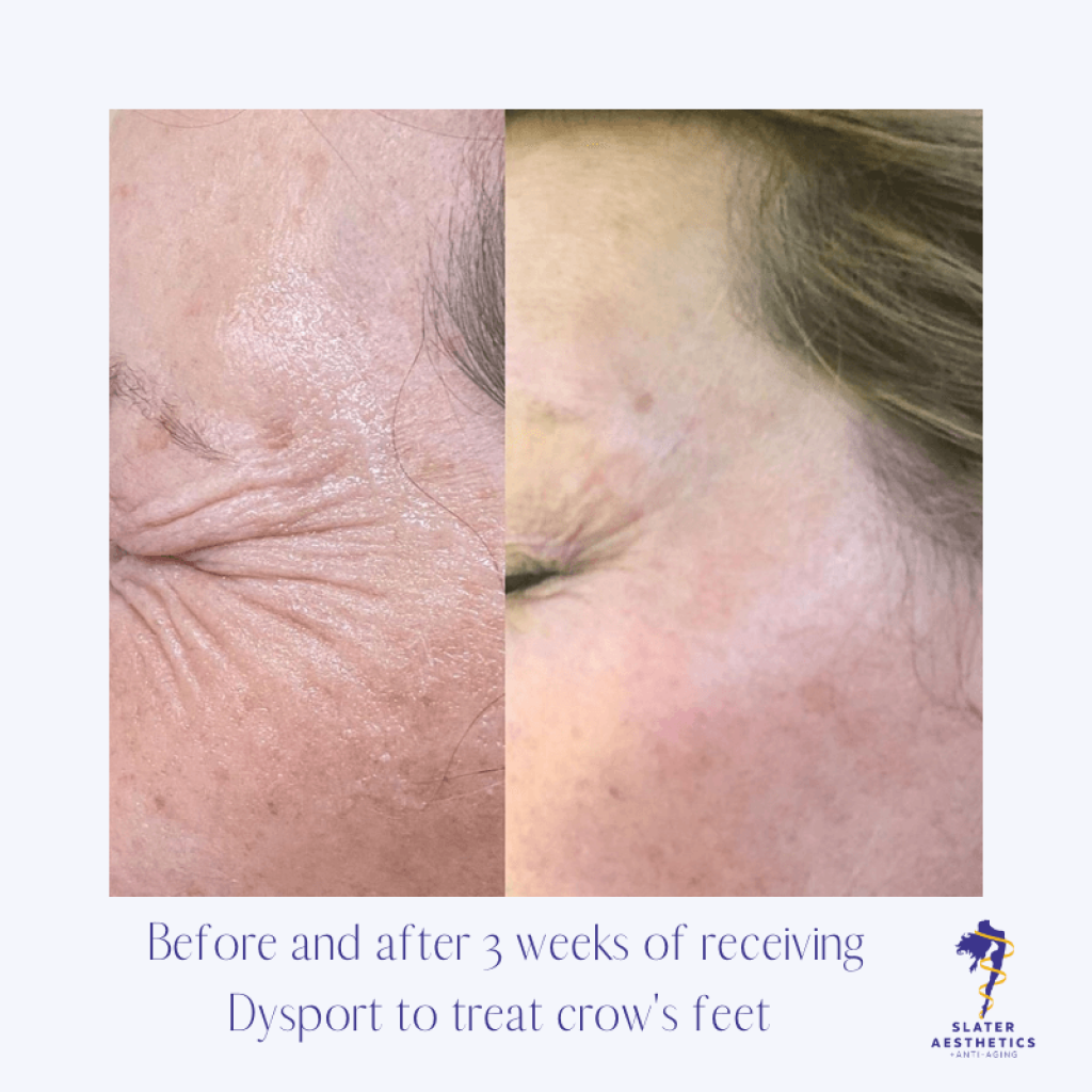 Before and after treatment of crow's-feet with Dysport
