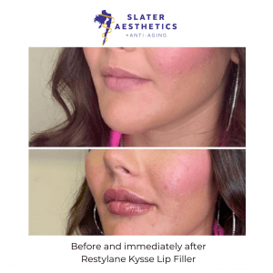 Before and immediately After Restylane Kysse Lip Filler