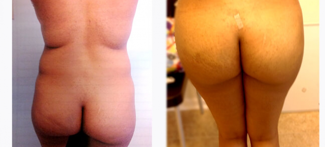 Brazilian Butt Lift