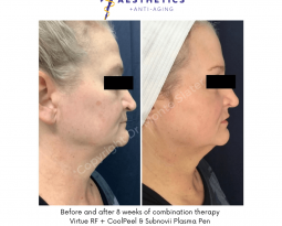 Virtue RF + CoolPeel