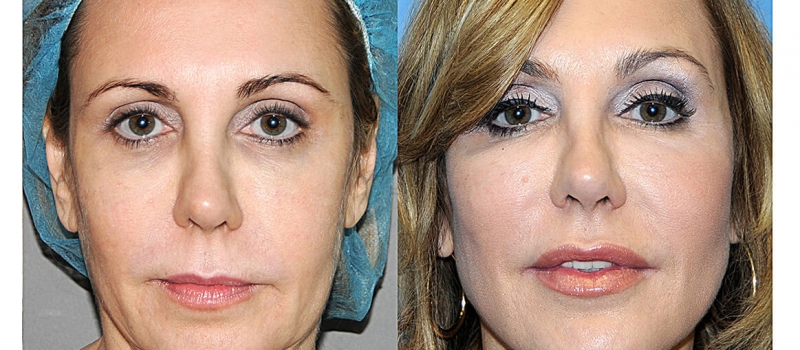 Y Lift ® Nonsurgical Facelift Lunchtime Facelift View Patient Photos